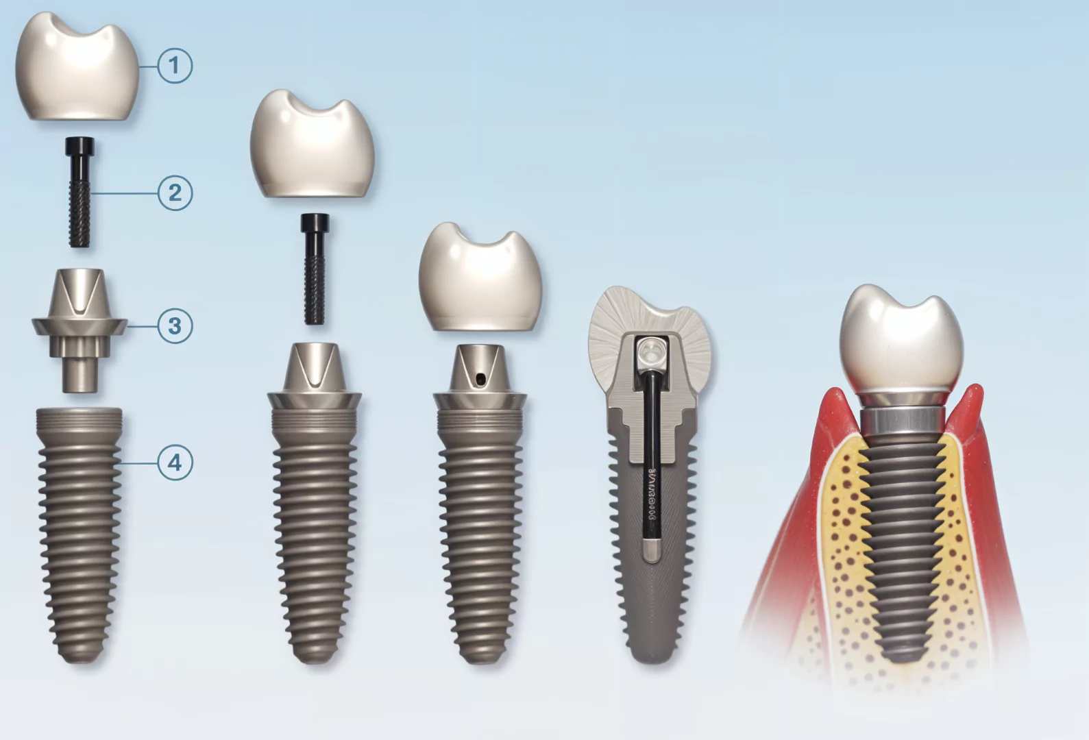 Dental Implant Parts
