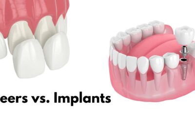 Dental Implants vs. Veneers: Which Option is Right for You?