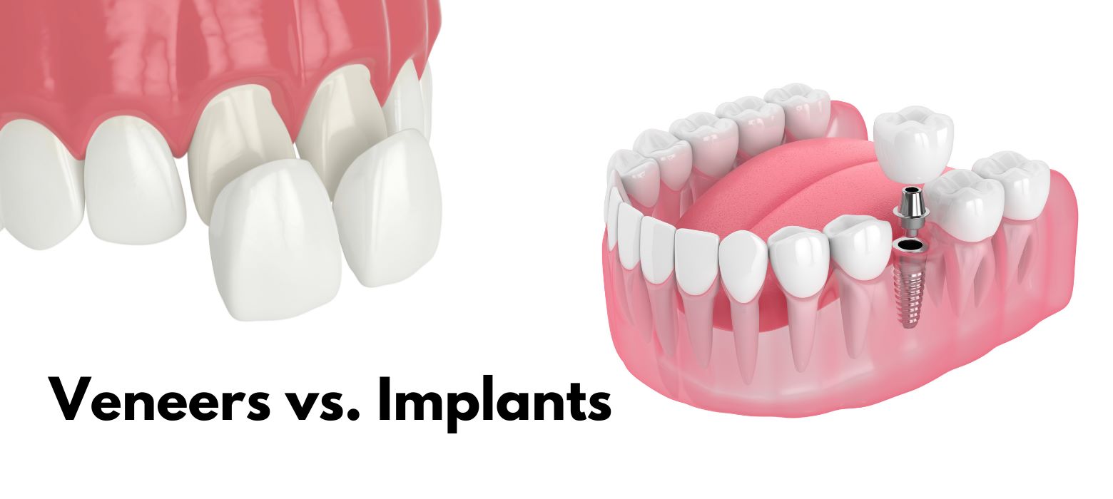 Dental Implants vs. Veneers