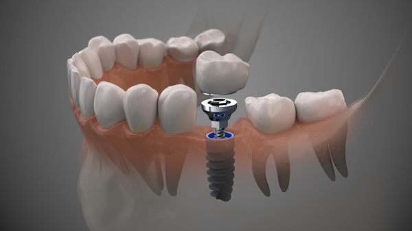 Dental Implants for Molars