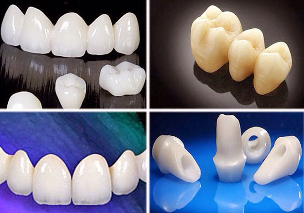 types-of-dental-porcelain-crown