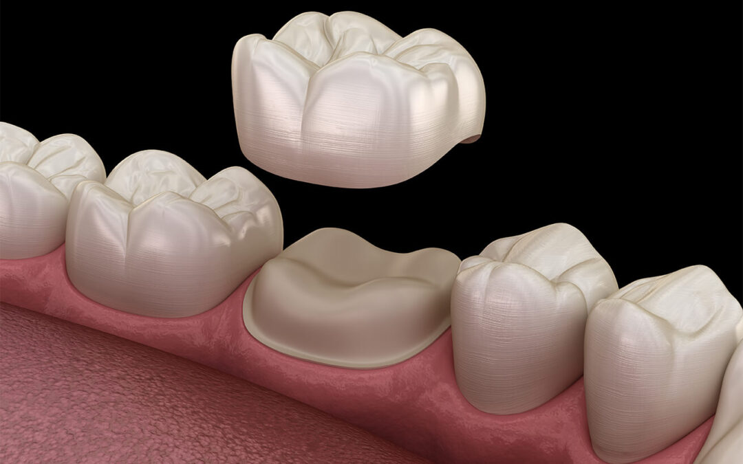 What to Do if an Implant  Crown Falls Out