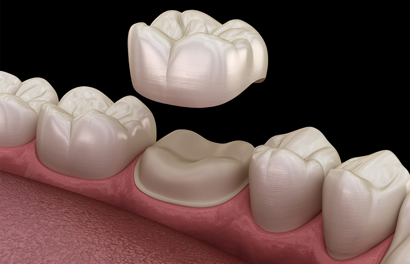 What to Do if an Implant  Crown Falls Out