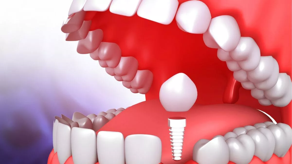 Cost of Same Day Dental Implants