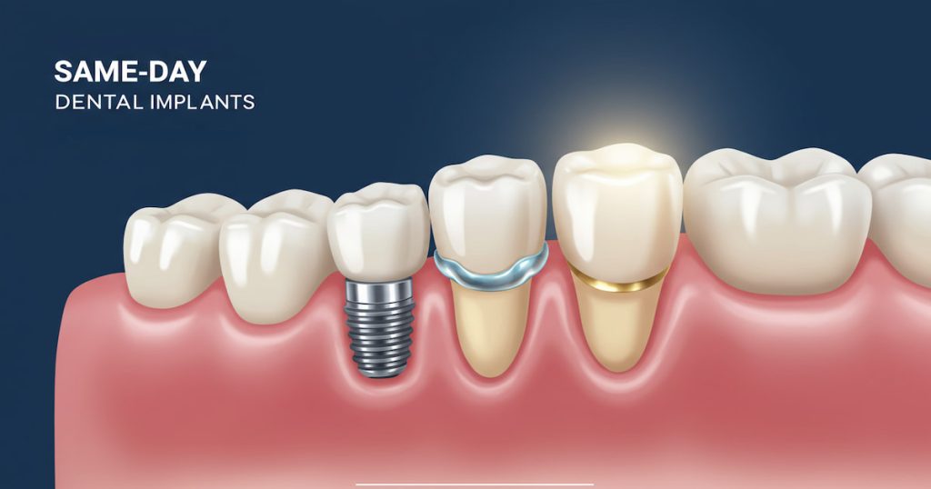 What Are Same Day Dental Implants
