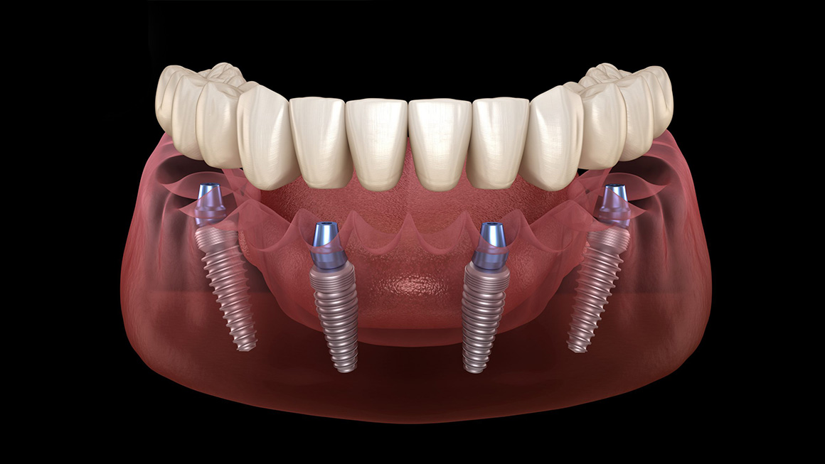 All-on-4 Dental Implants
