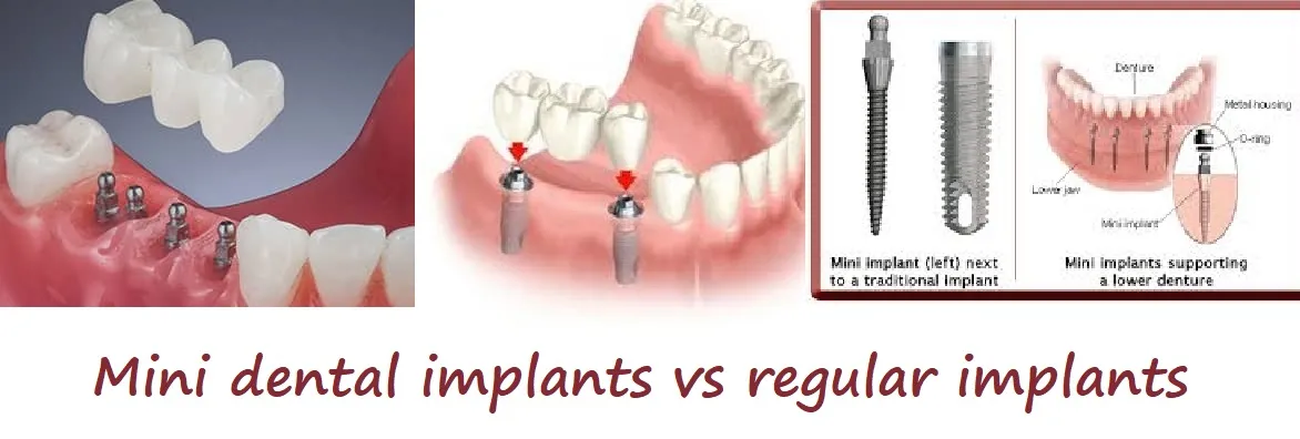 Mini Dental Implants vs. Traditional Implants Procedure