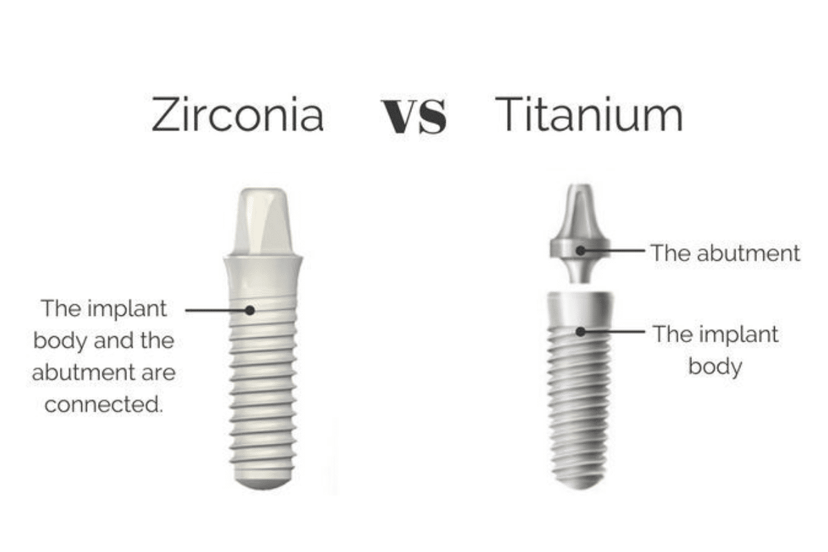 Dental Implants Zirconia vs Titanium