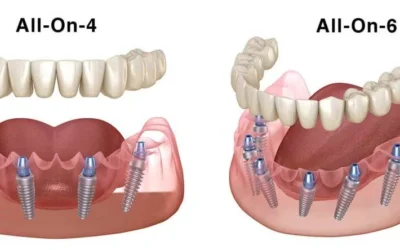 All on 4 vs All on 6 Dental Implants: Understanding the Differences and Best Options for You