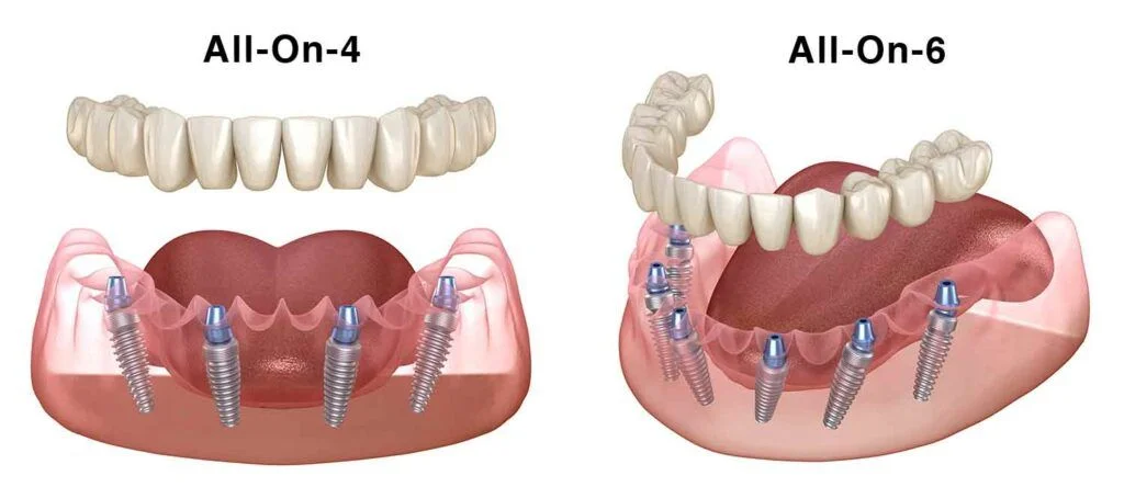 all-on-4-vs-all-on-6-dental-implants-1024×444-1 All on 4 vs All on 6 Dental Implants