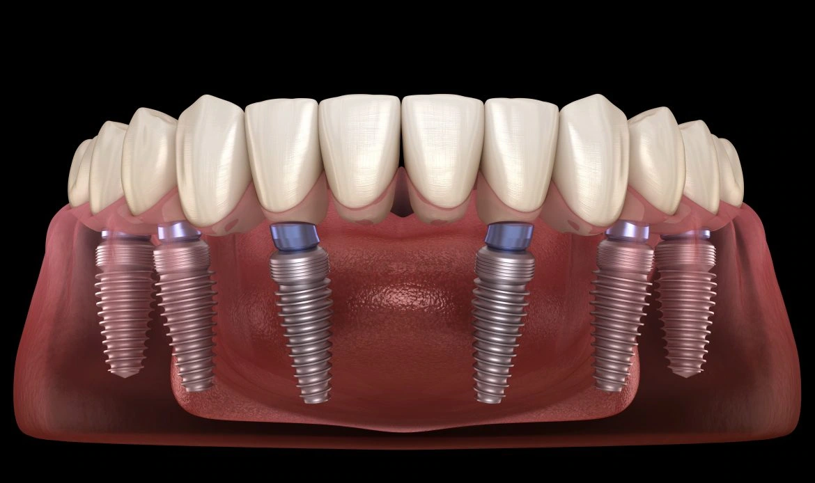 All-on-6 Dental Implants