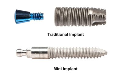 Mini Dental Implants vs. Traditional Implants: Your Ultimate Guide to Cost, Procedure, and Longevity