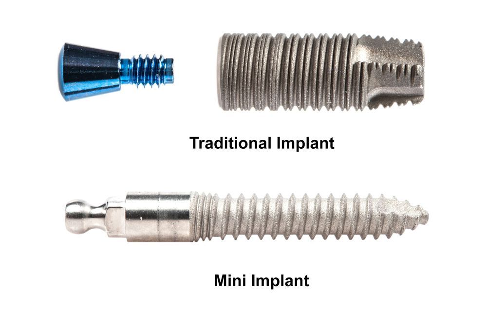 Mini Dental Implants vs. Traditional Implants: Your Ultimate Guide to Cost, Procedure, and Longevity