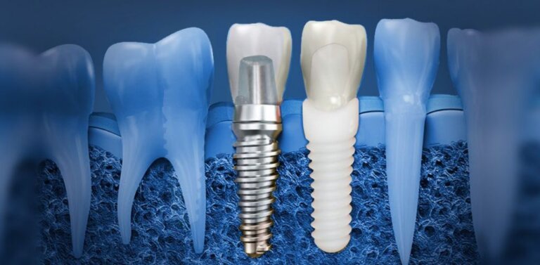 disadvantages of titanium implants