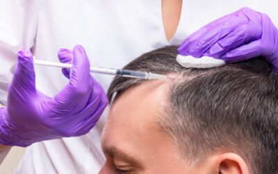 Alternative Hair Restoration In Turkey: PRP vs. Hair Transplants