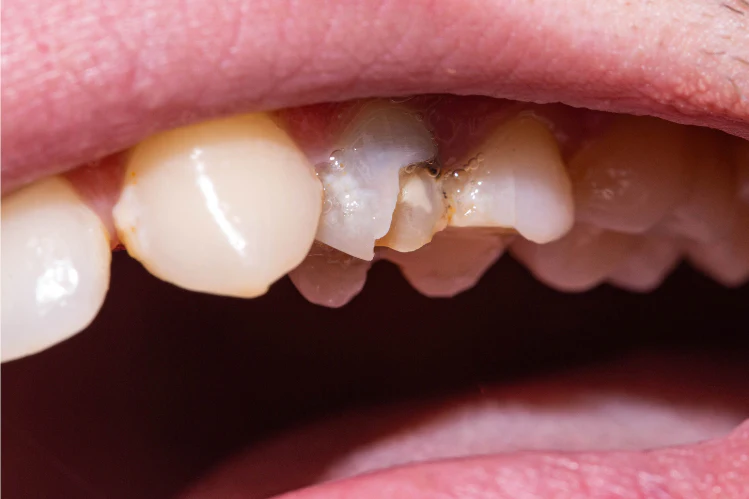 How to Fix a Cracked Tooth