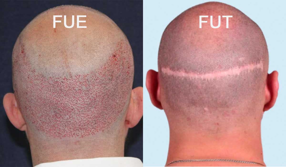 Follicular Unit Transplantation (FUT)