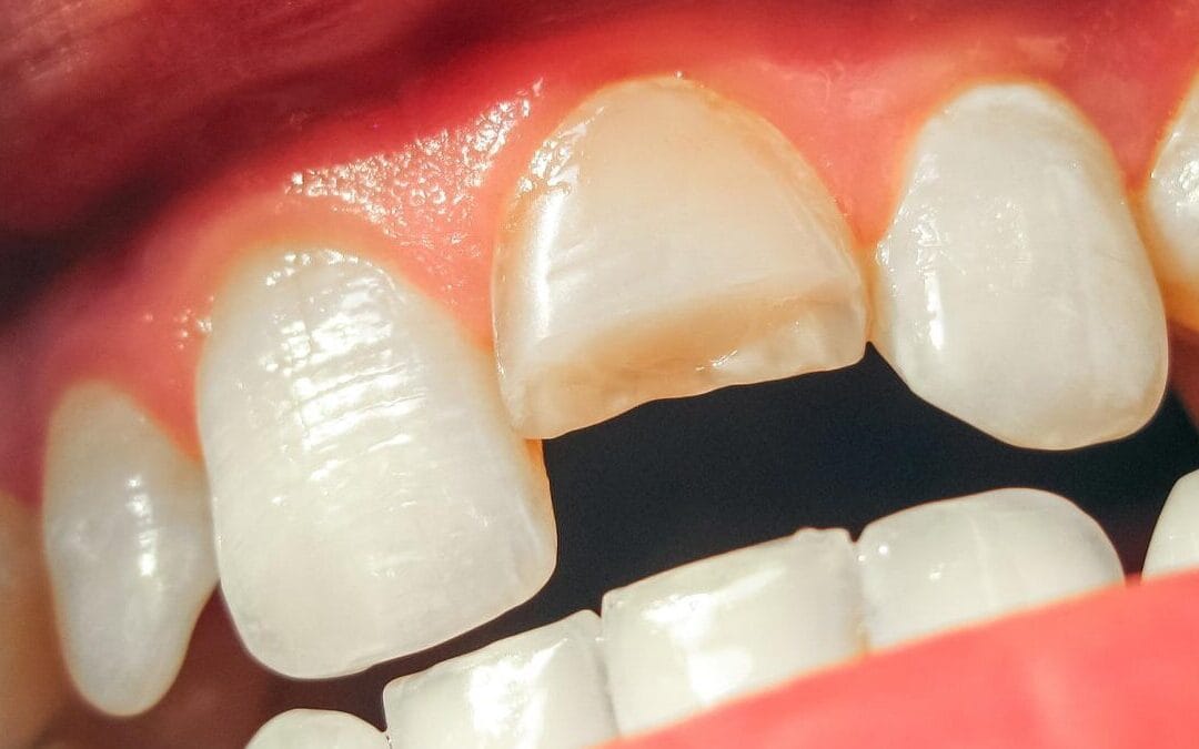 Is Your Smile at Risk? The Ultimate Guide to Cracked Tooth Repair