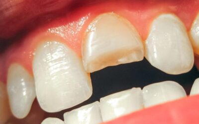 Is Your Smile at Risk? The Ultimate Guide to Cracked Tooth Repair