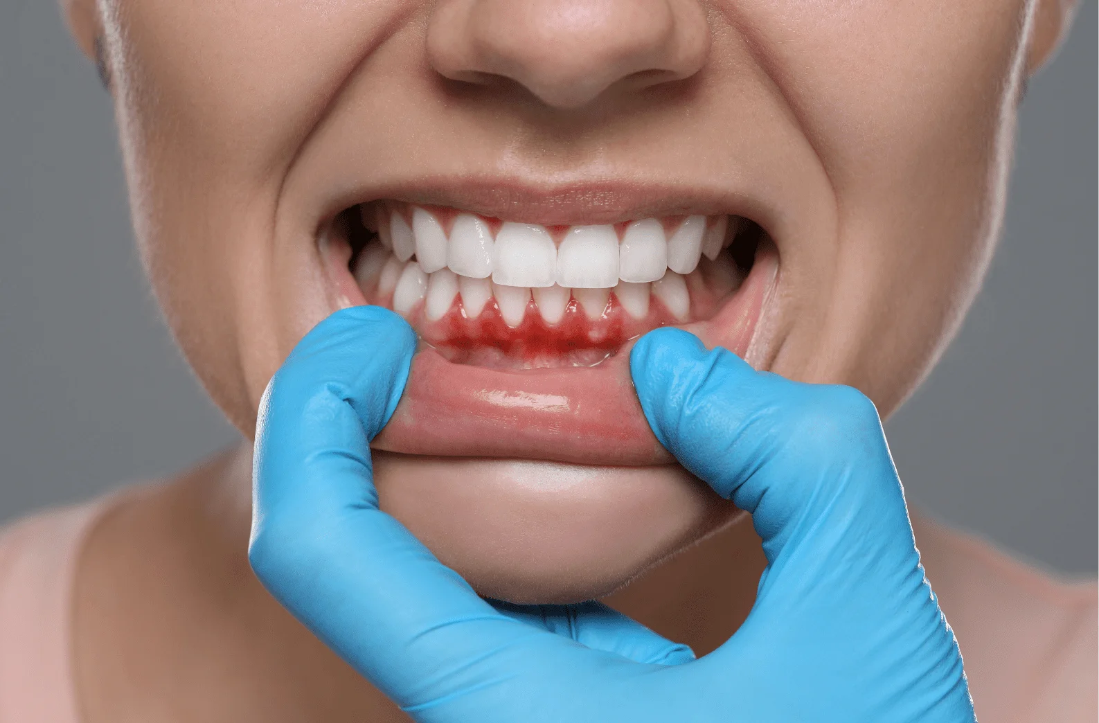 Gum Graft Surgery