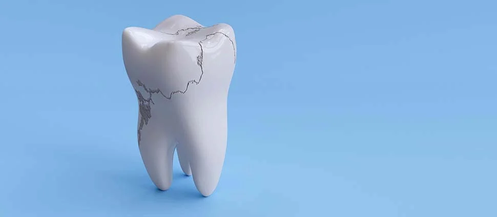 Cracked Tooth Repair Cost