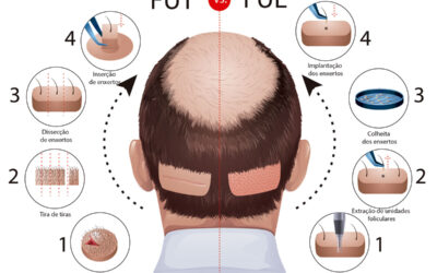 FUE vs FUT Hair Transplant in Turkey: The Ultimate Guide to Cost, Scars, and Results