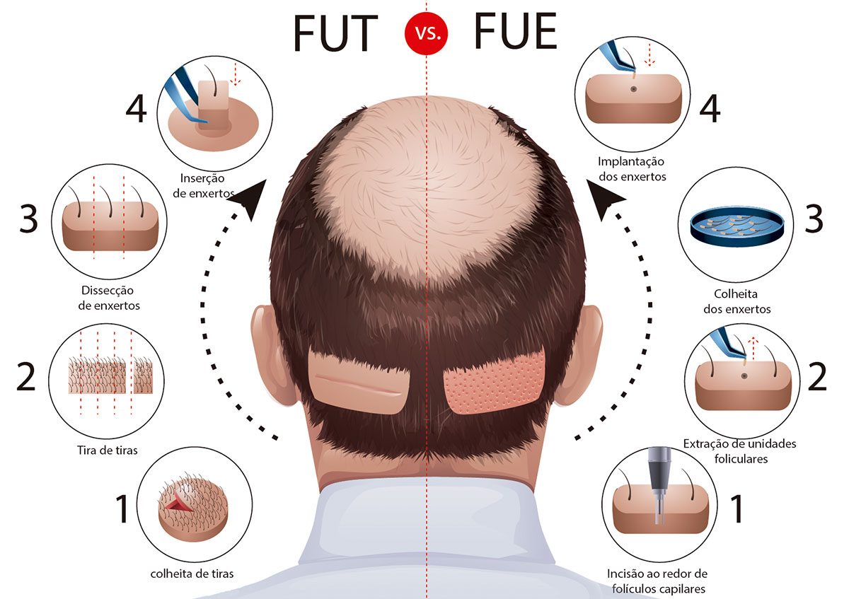 fut-fue FUE vs FUT Hair Transplant