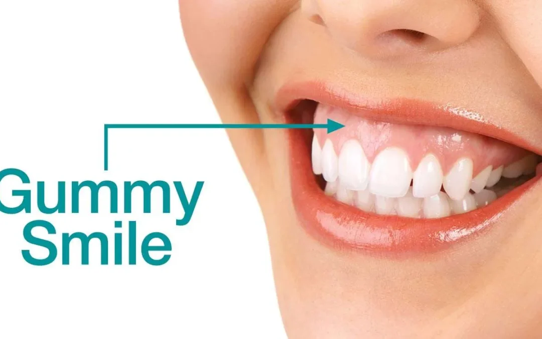 Gummy Smile Treatment in Turkey: How to Fix a Gummy Smile Permanently