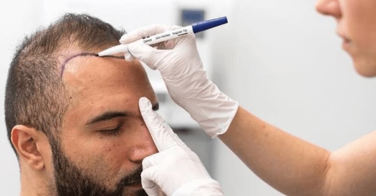 Average Price for Hair Transplant in Turkey