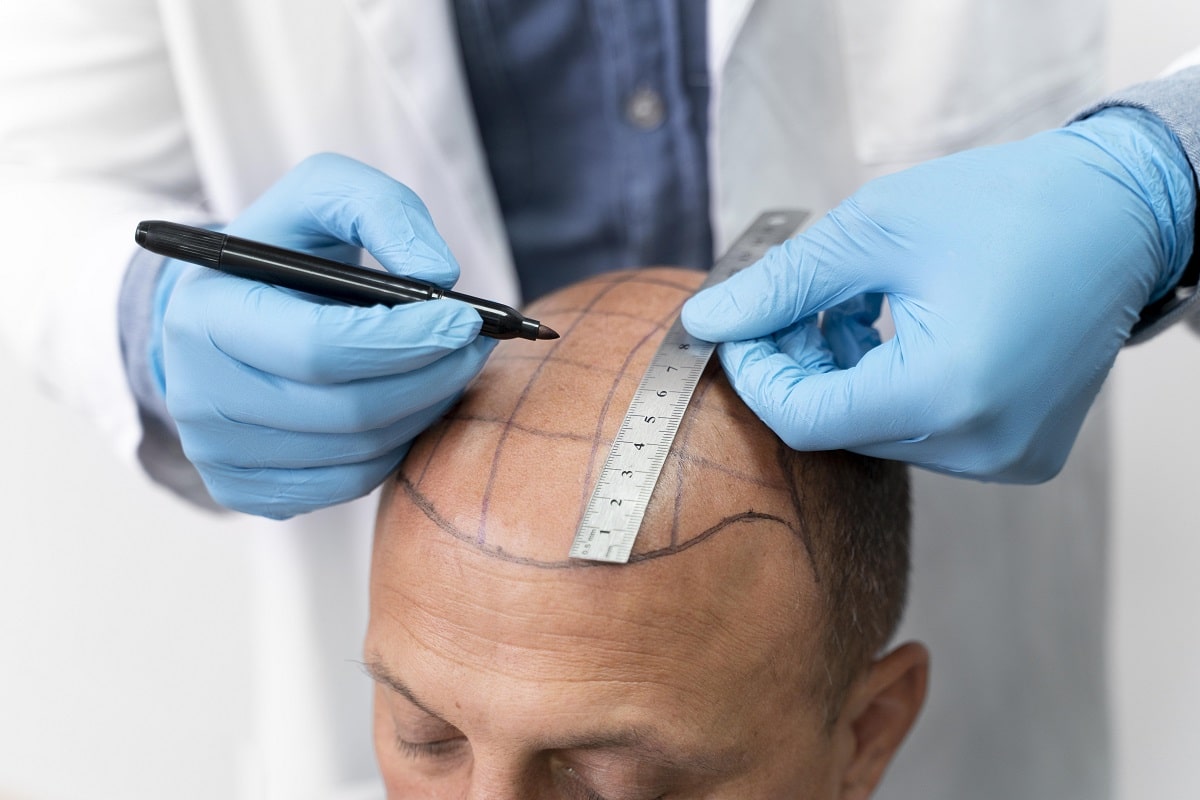 Hair Transplant Cost Turkey vs. UK