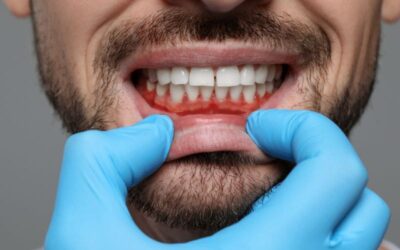 When Is It Too Late for Gum Grafting? What You Need to Know