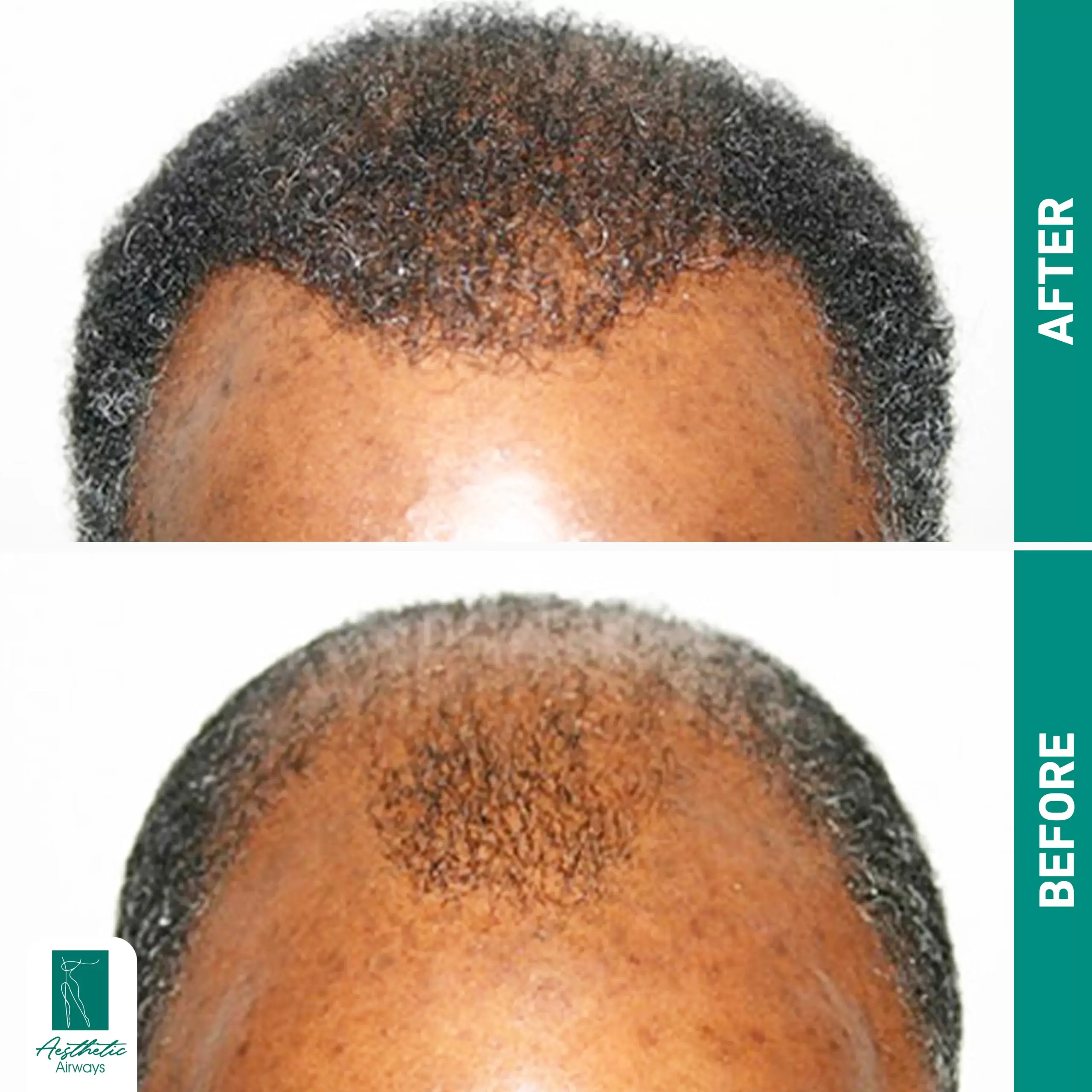 Hair Transplant