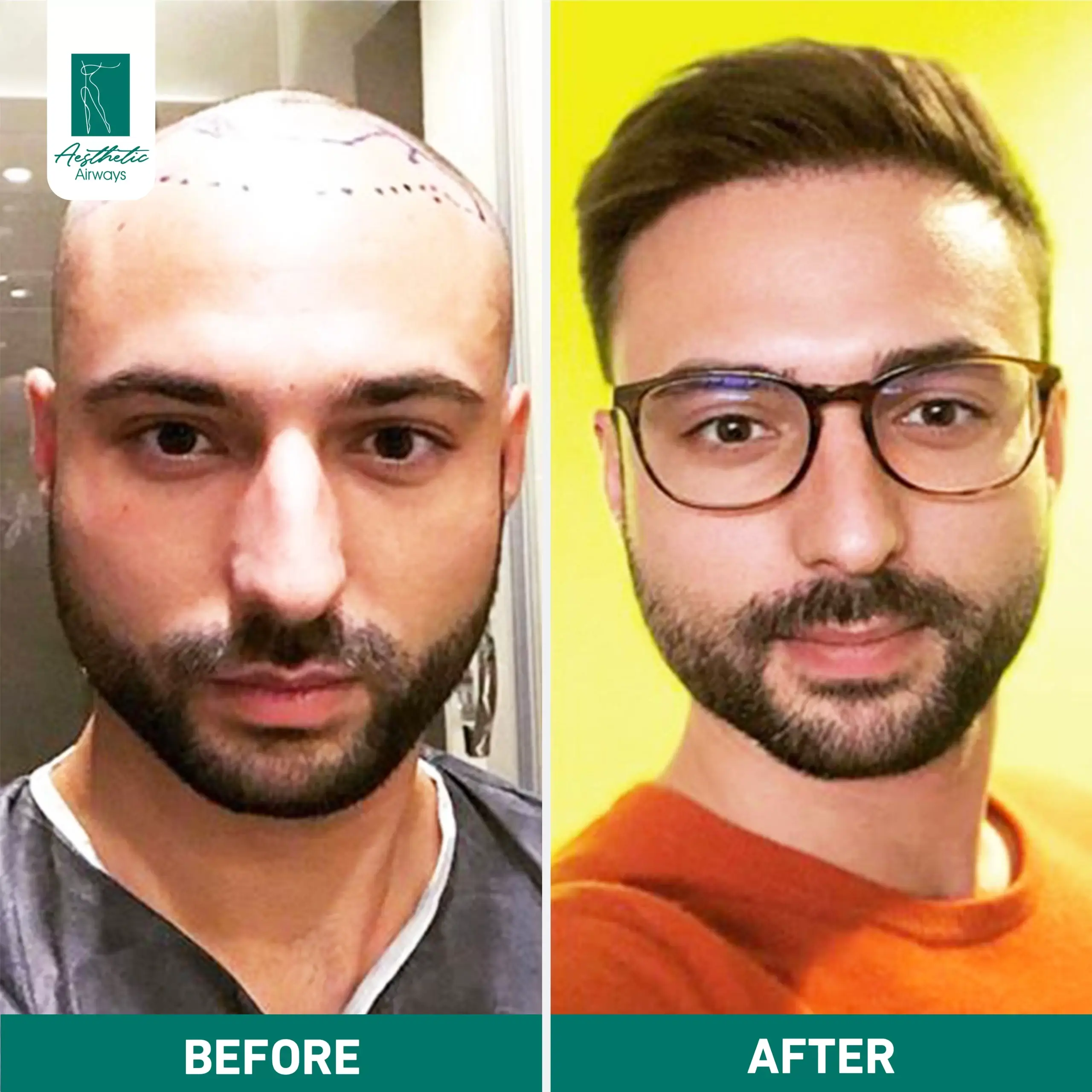 Hair Transplant
