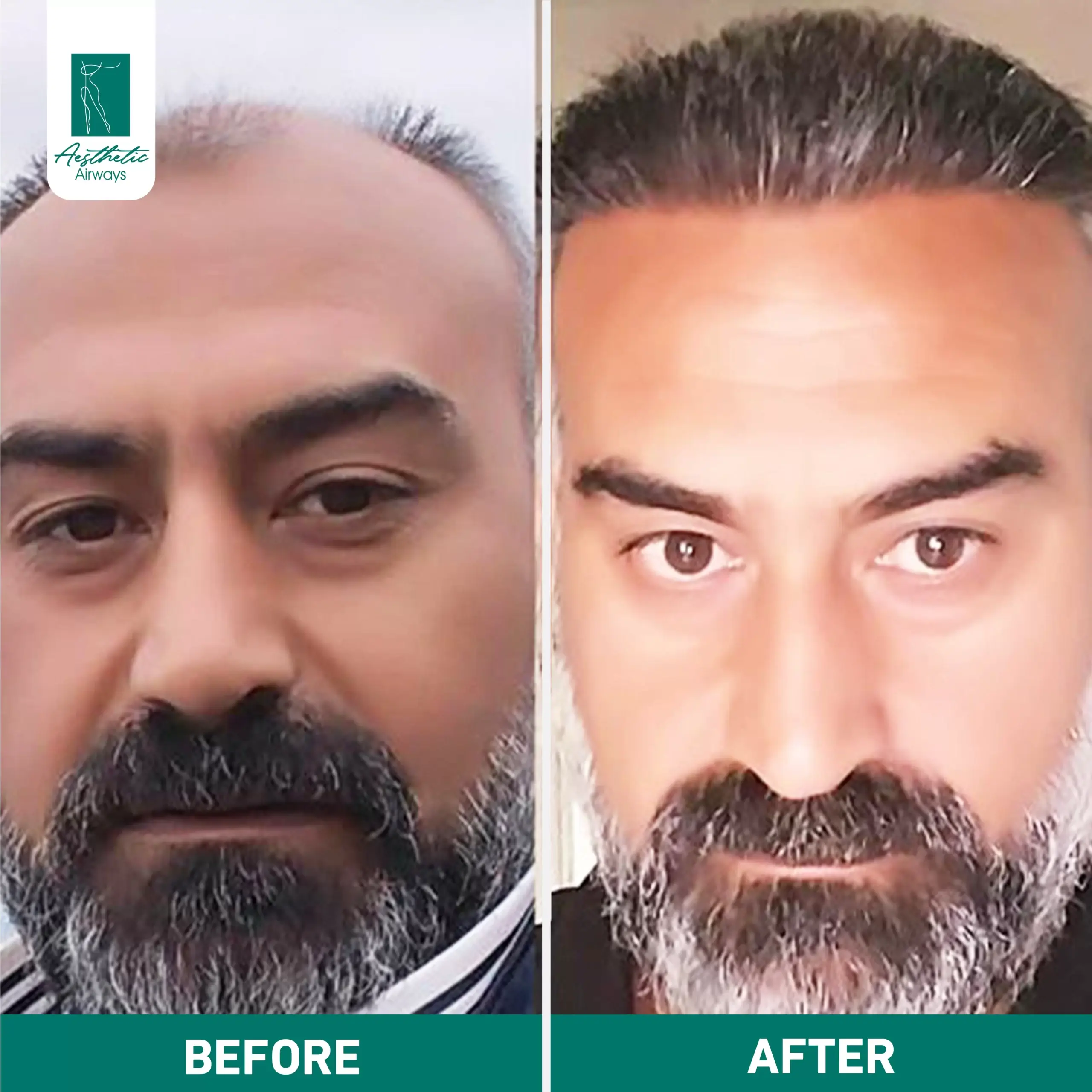 Hair Transplant