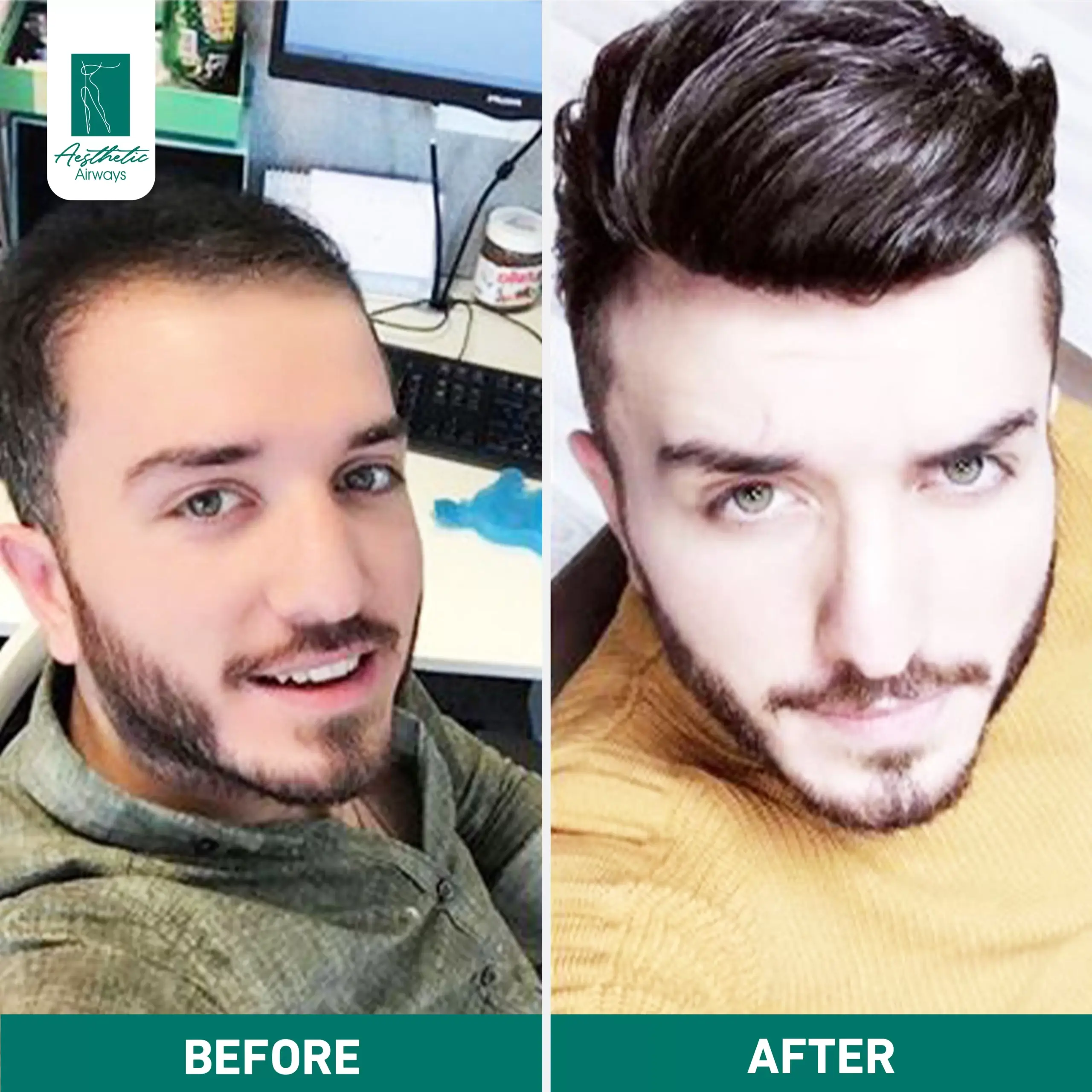 Hair Transplant