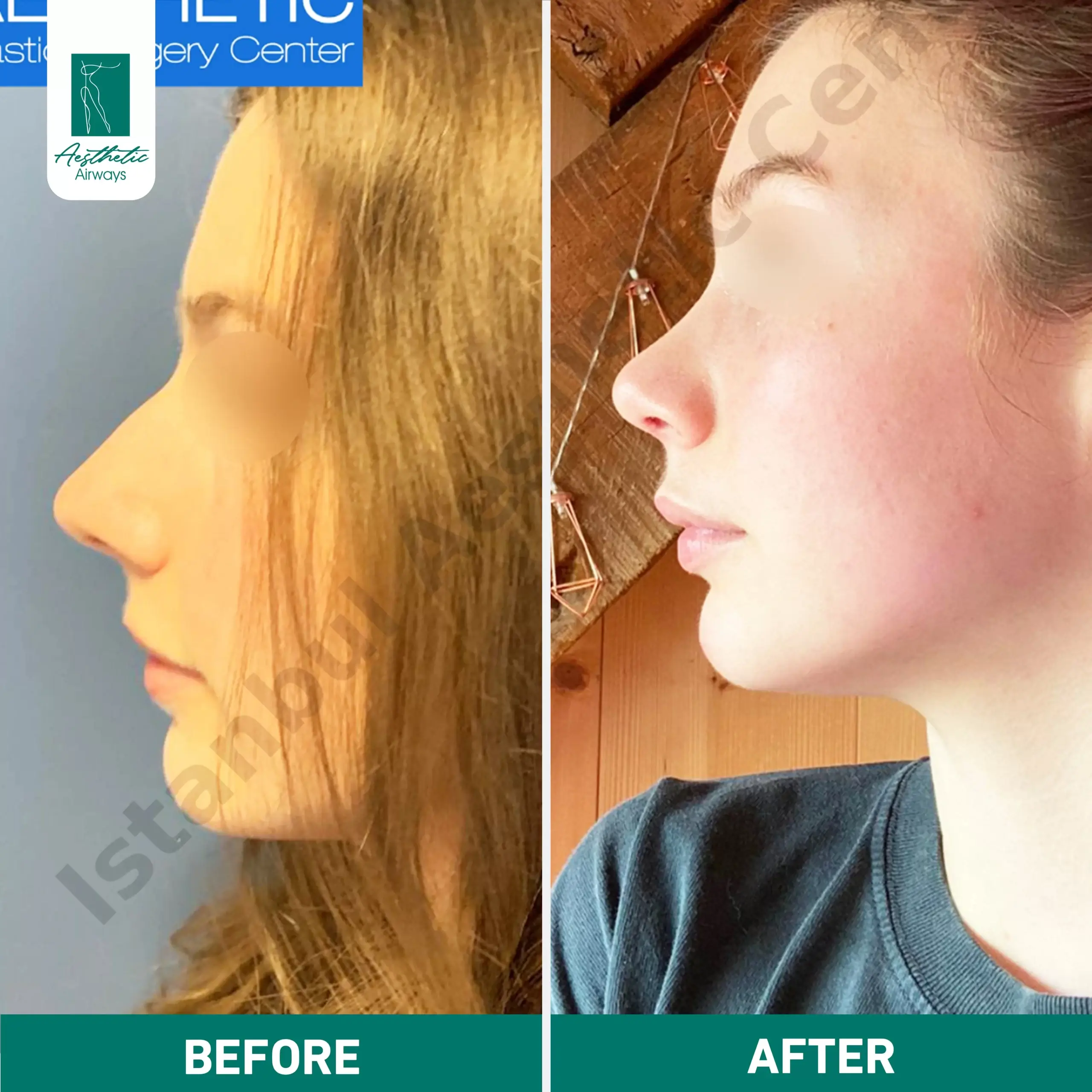 Nose surgery