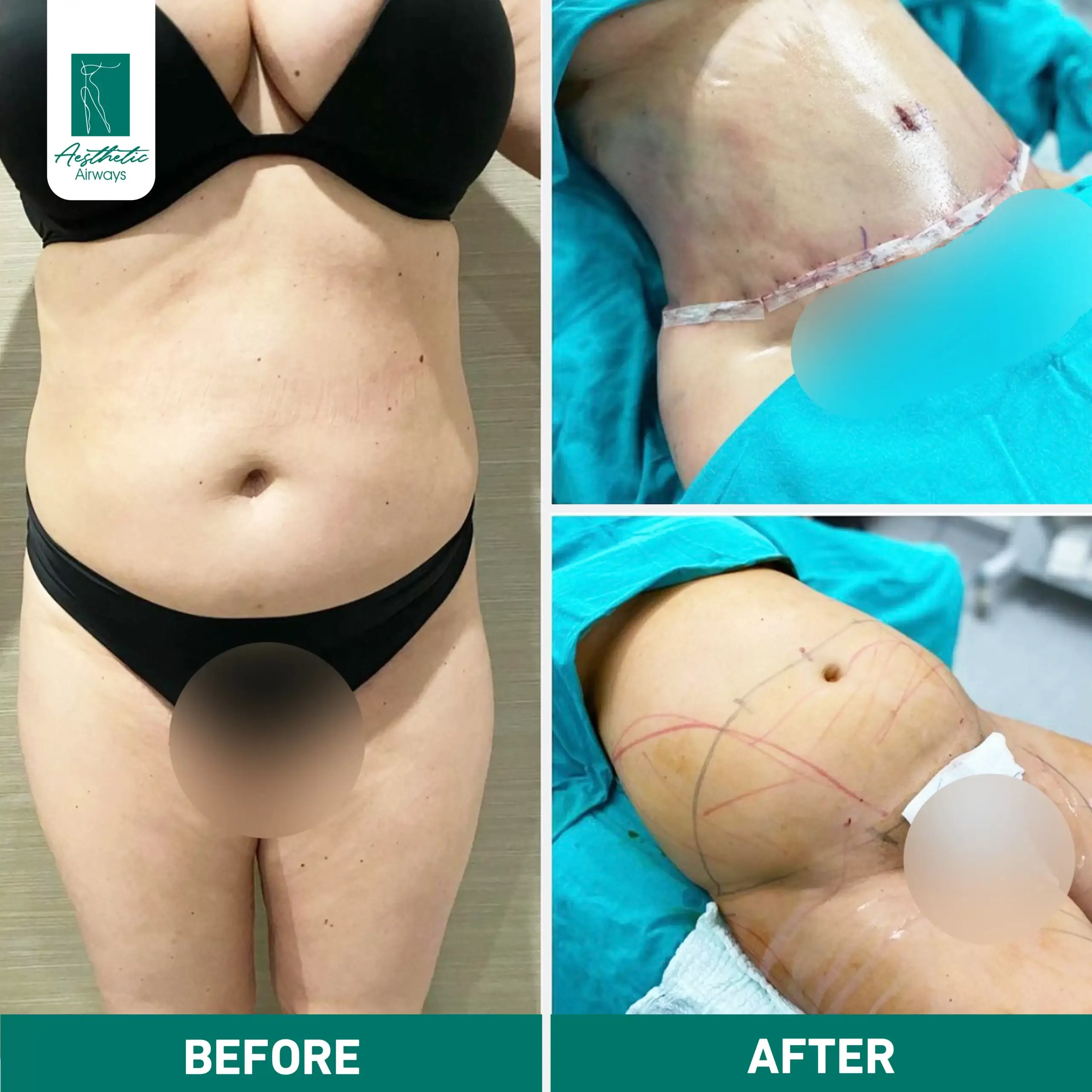 Body surgery