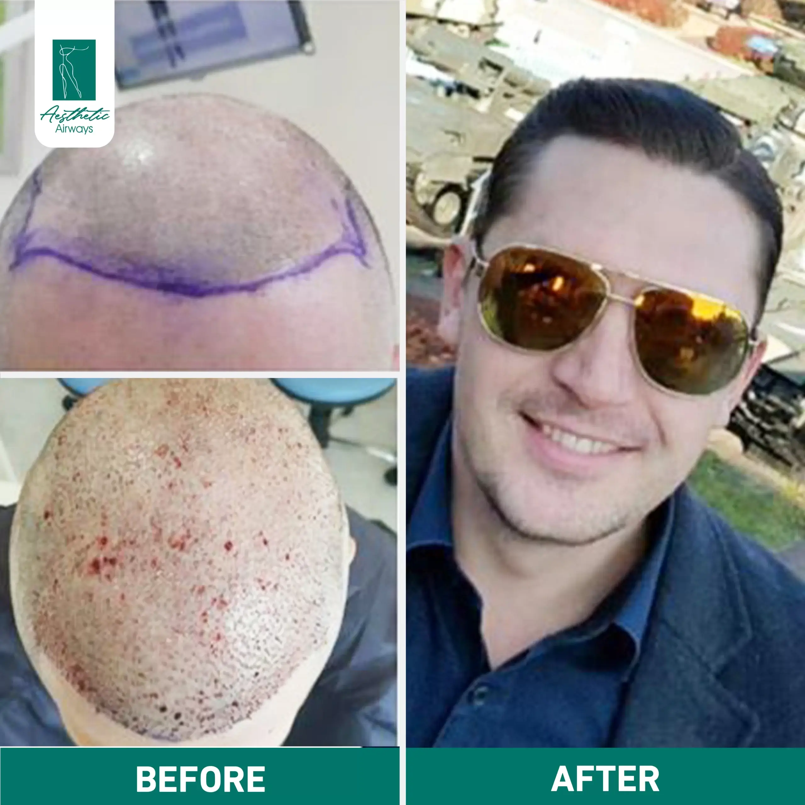 Hair Transplant