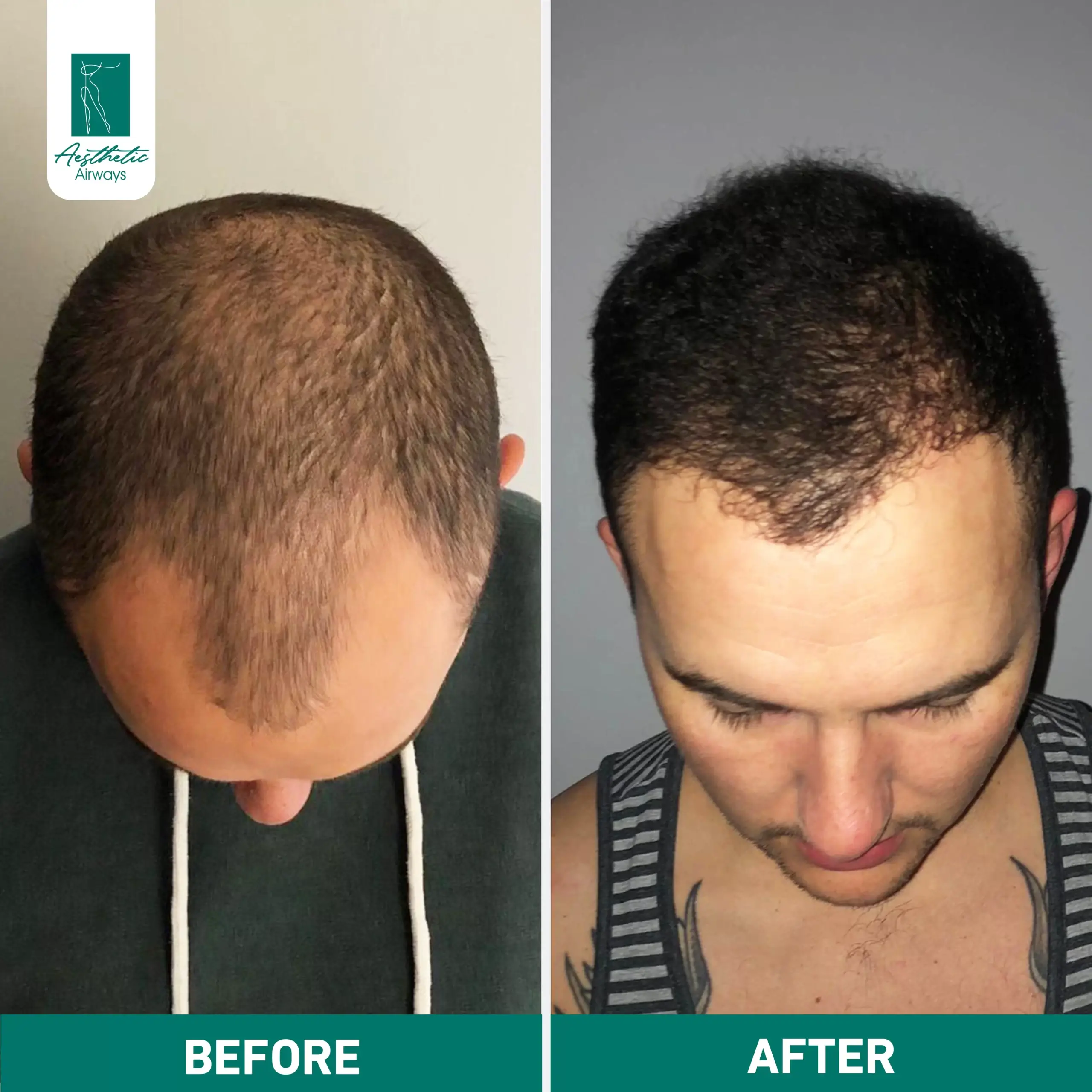 Hair Transplant