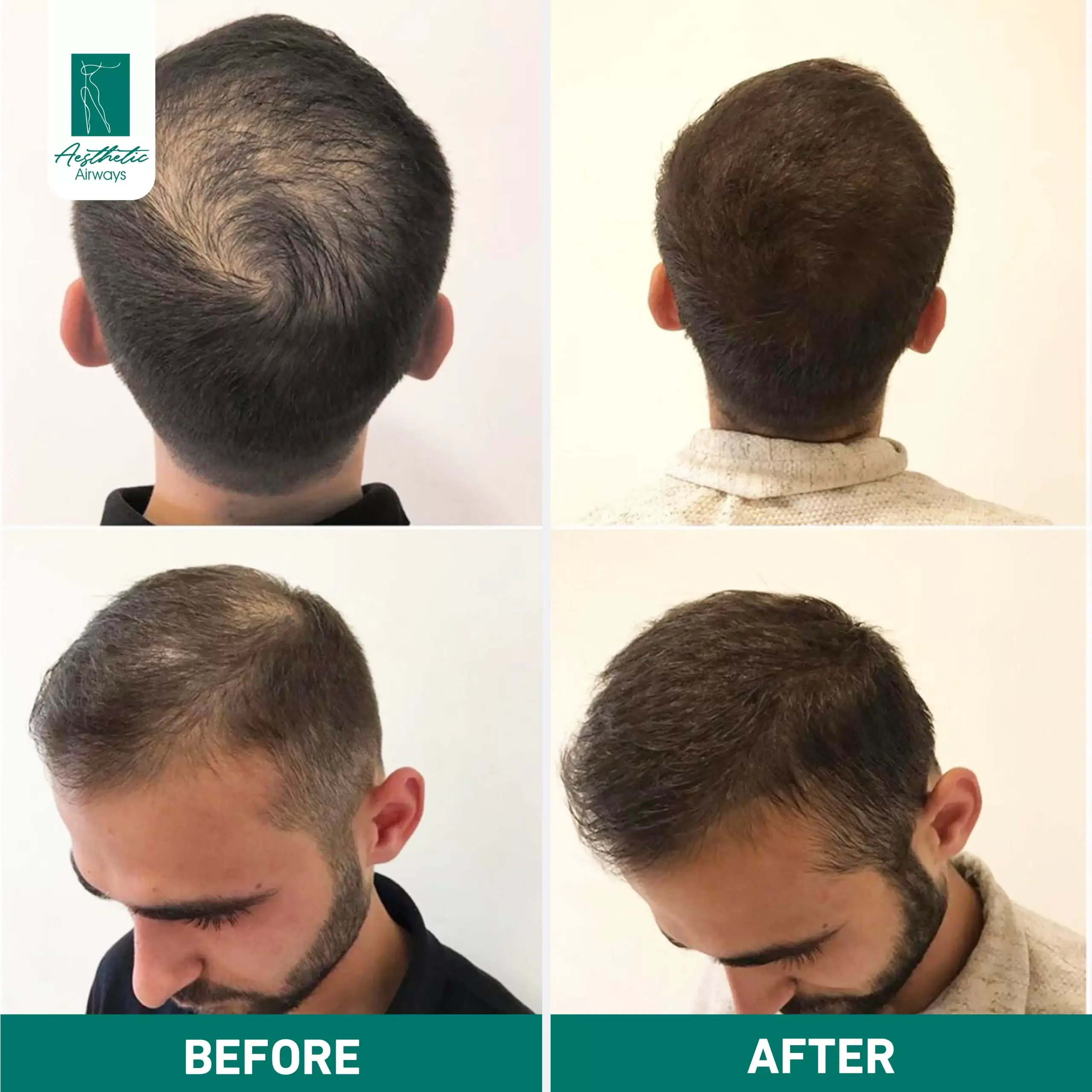 Hair Transplant