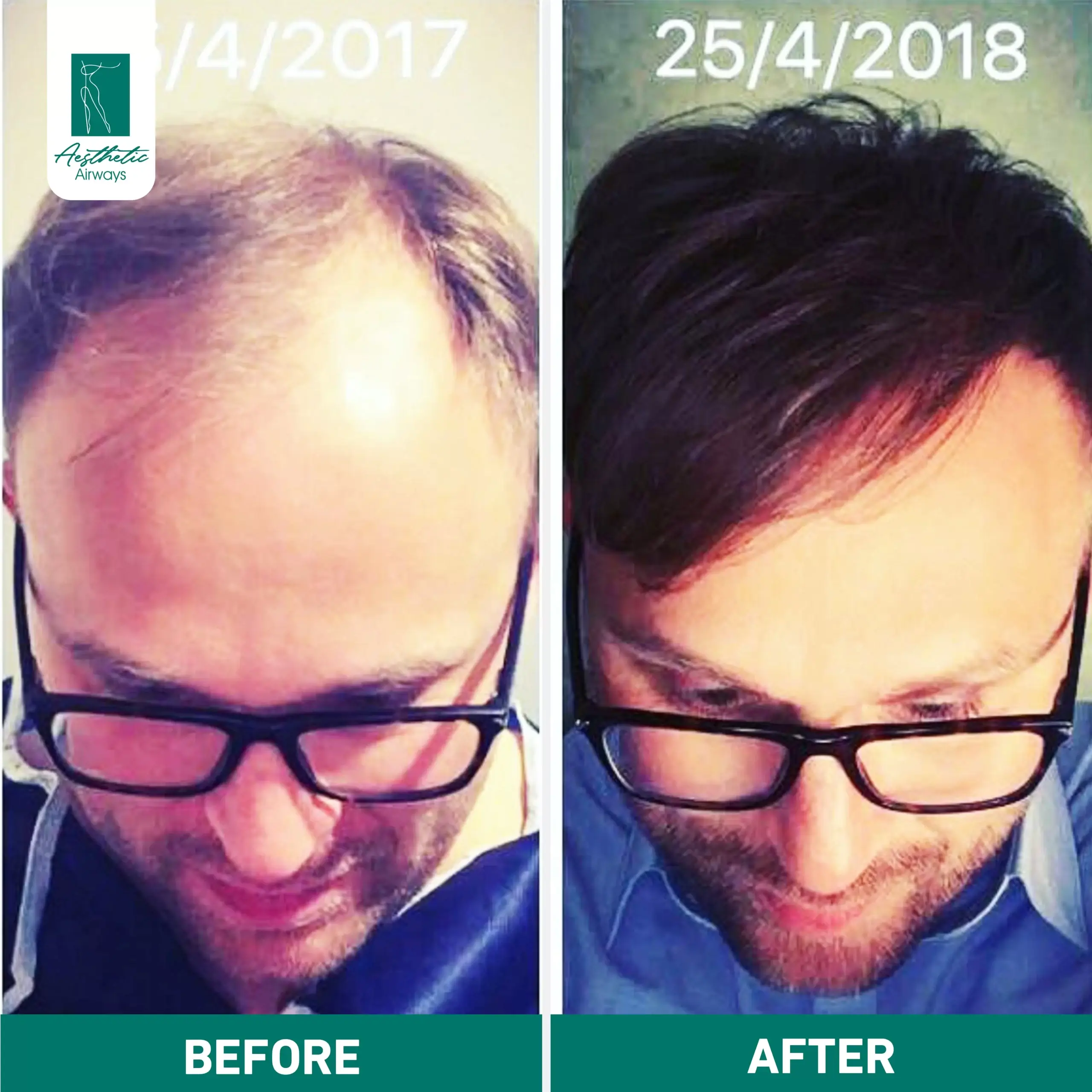 Hair Transplant