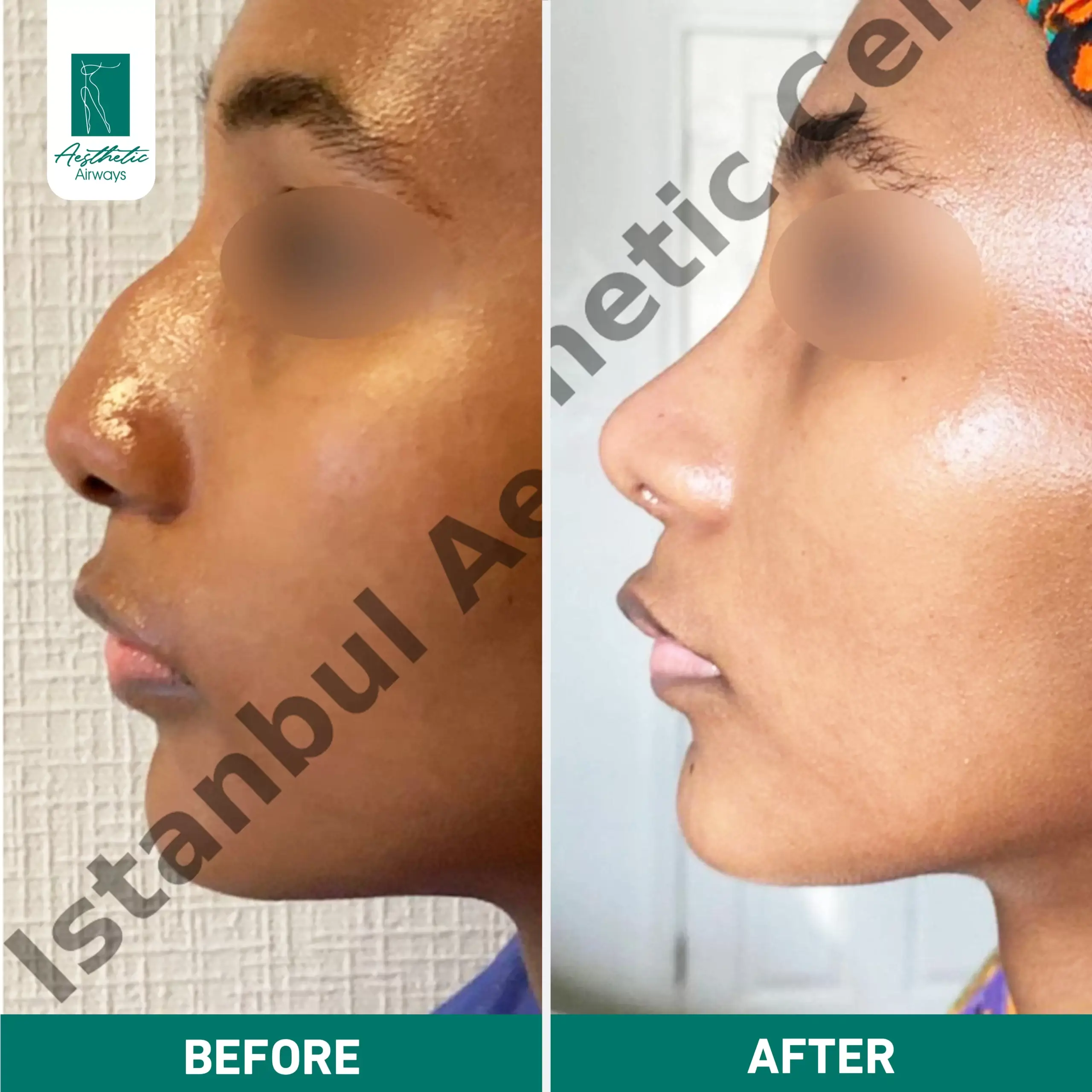 Nose surgery