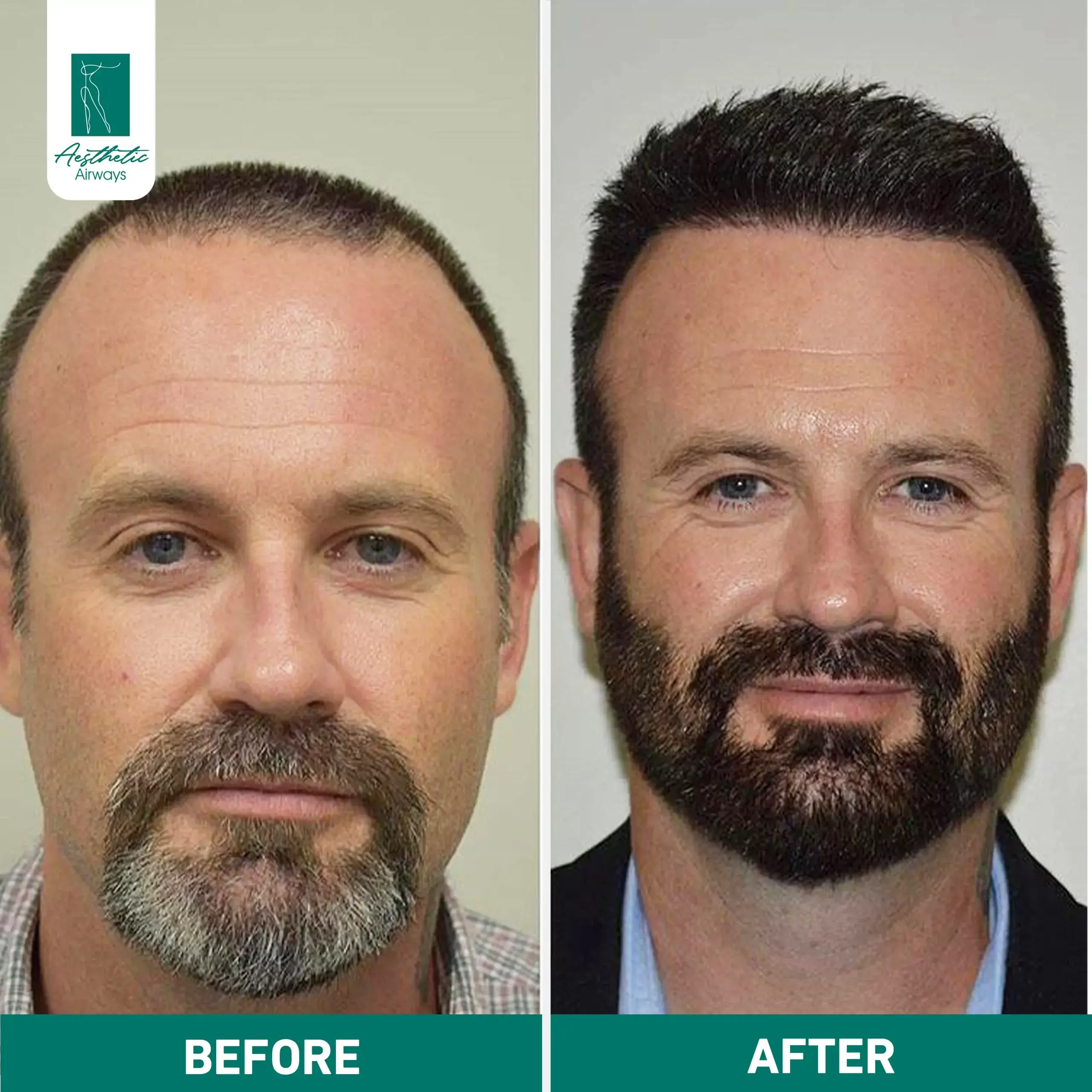 Hair Transplant