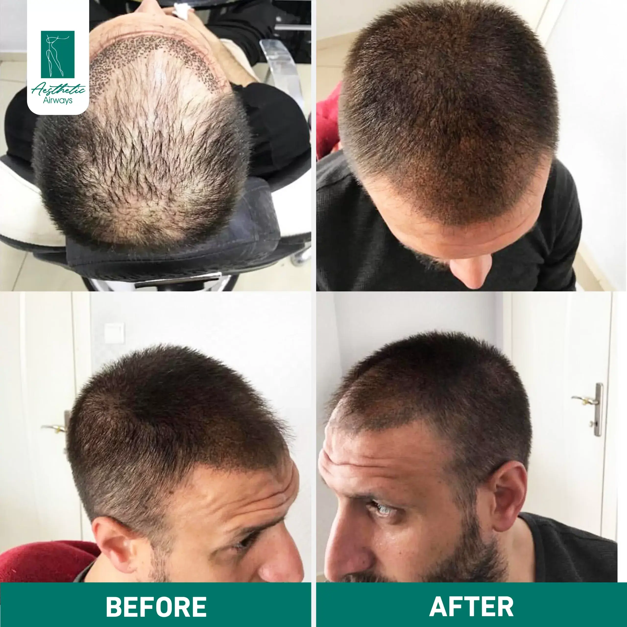 Hair Transplant