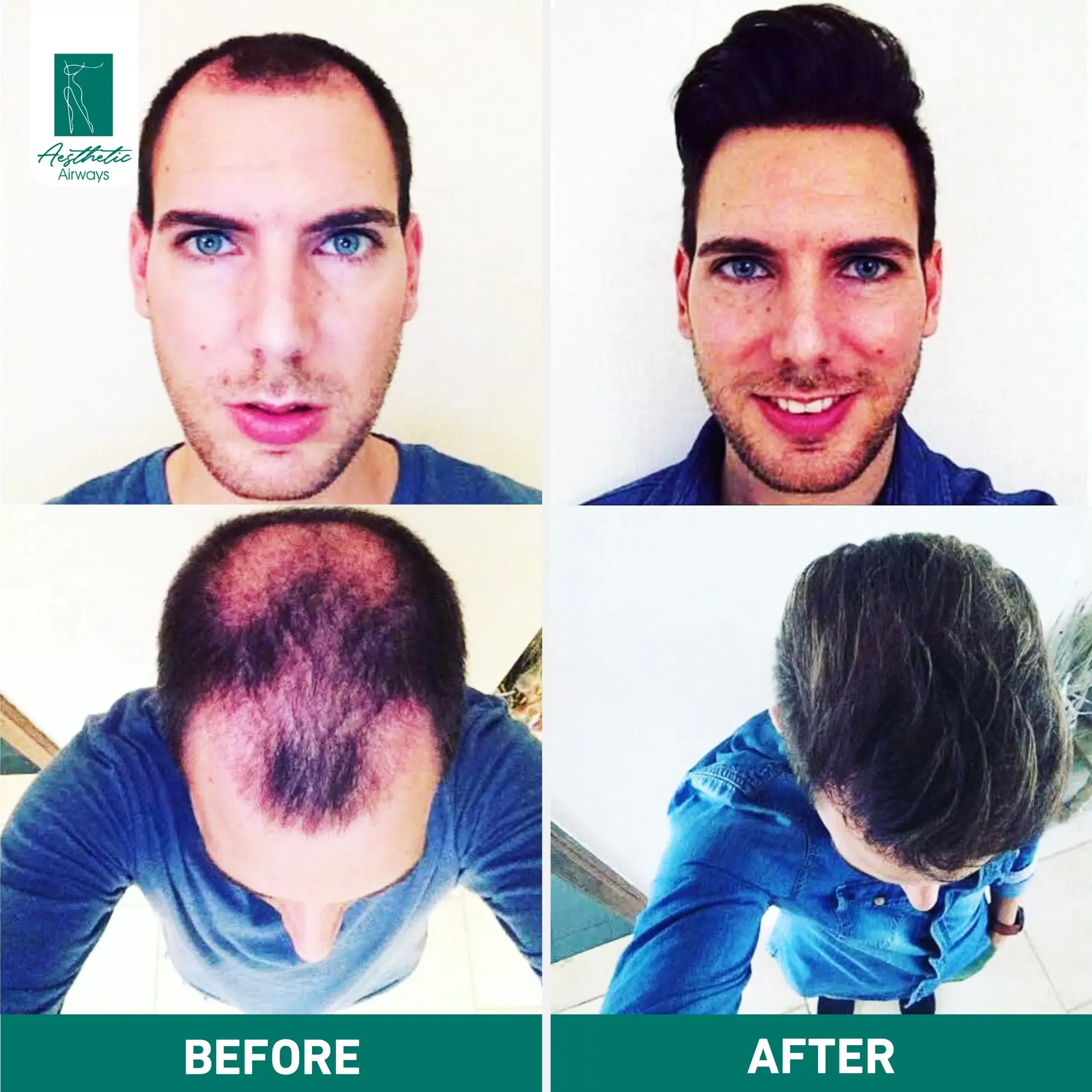 Hair Transplant