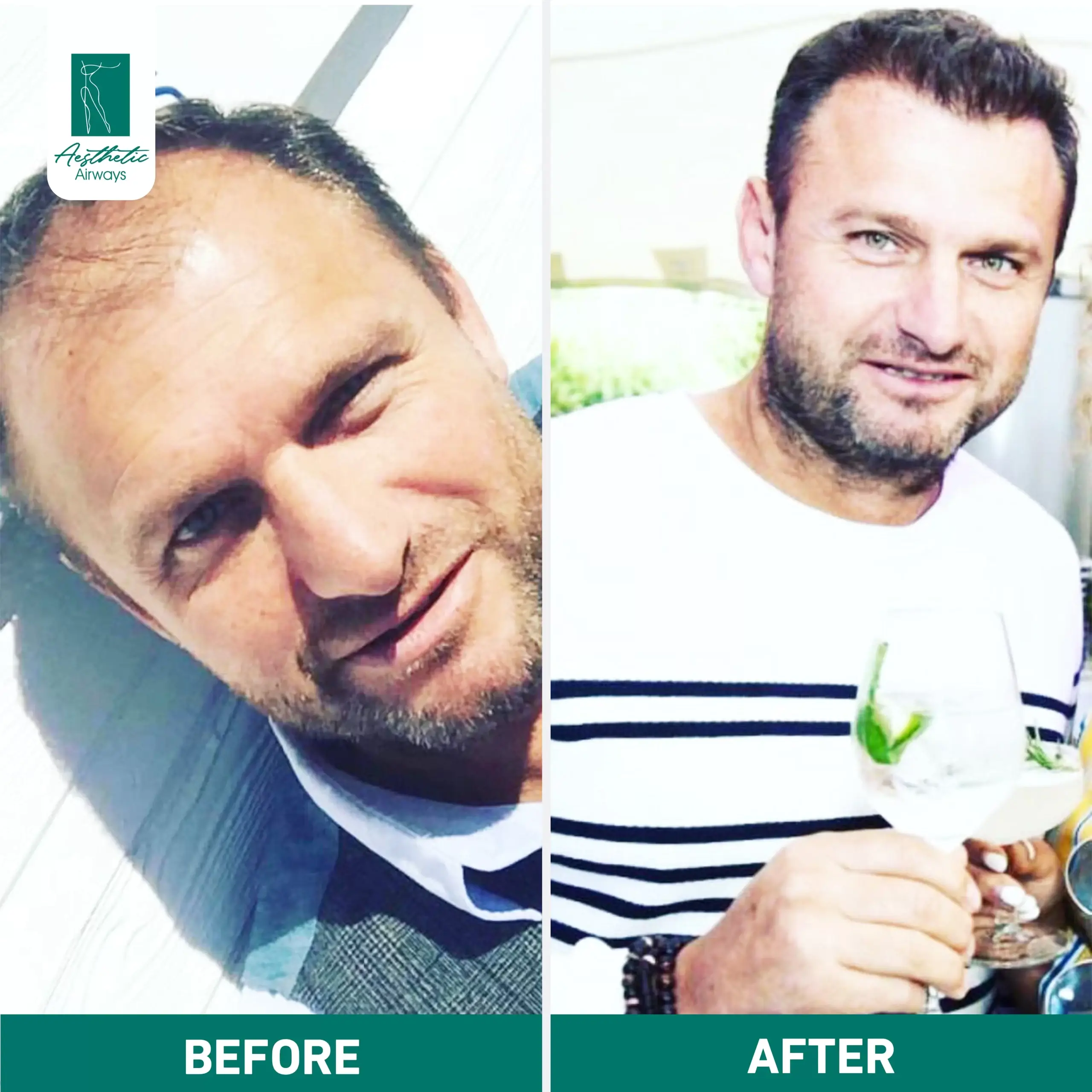Hair Transplant