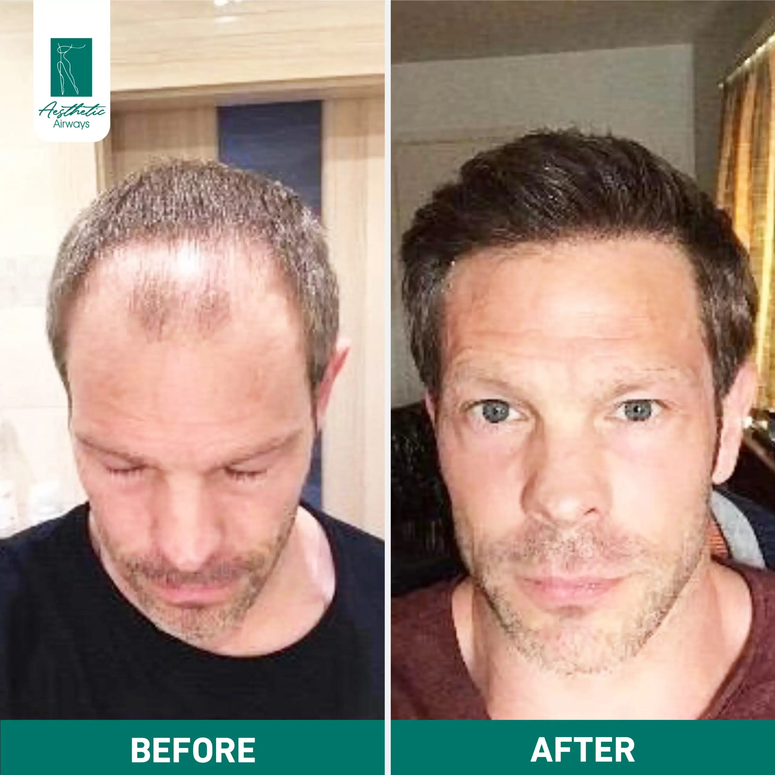 Hair Transplant