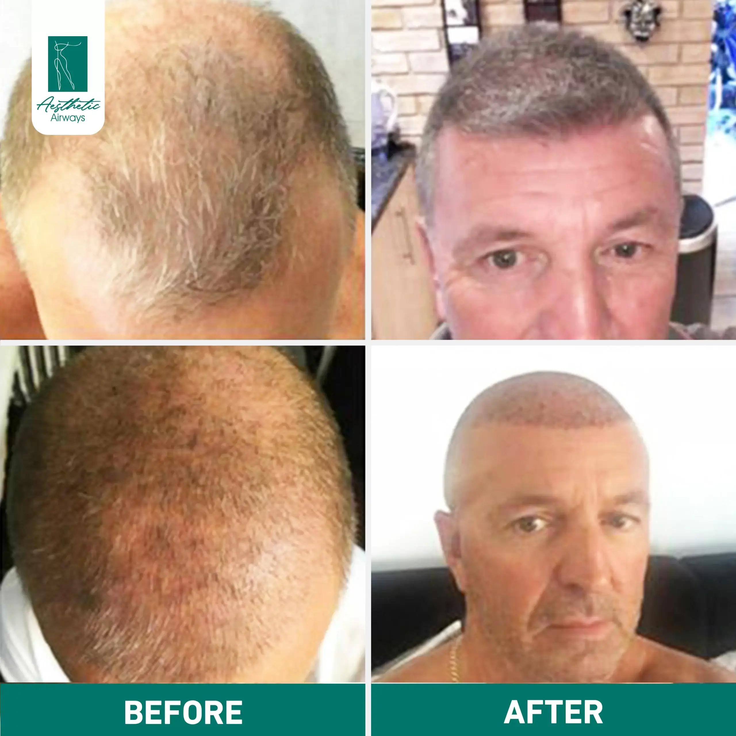 Hair Transplant