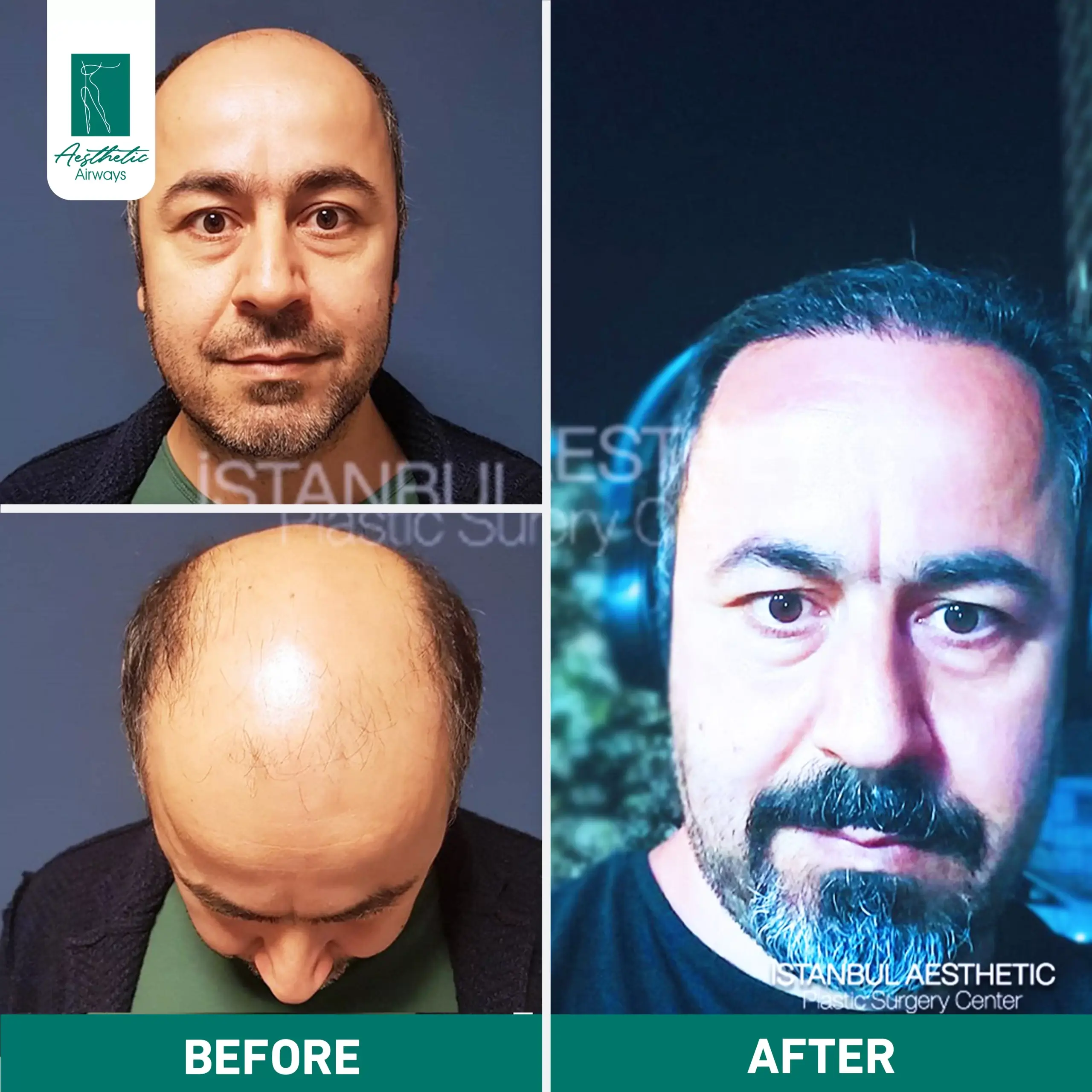 Hair Transplant