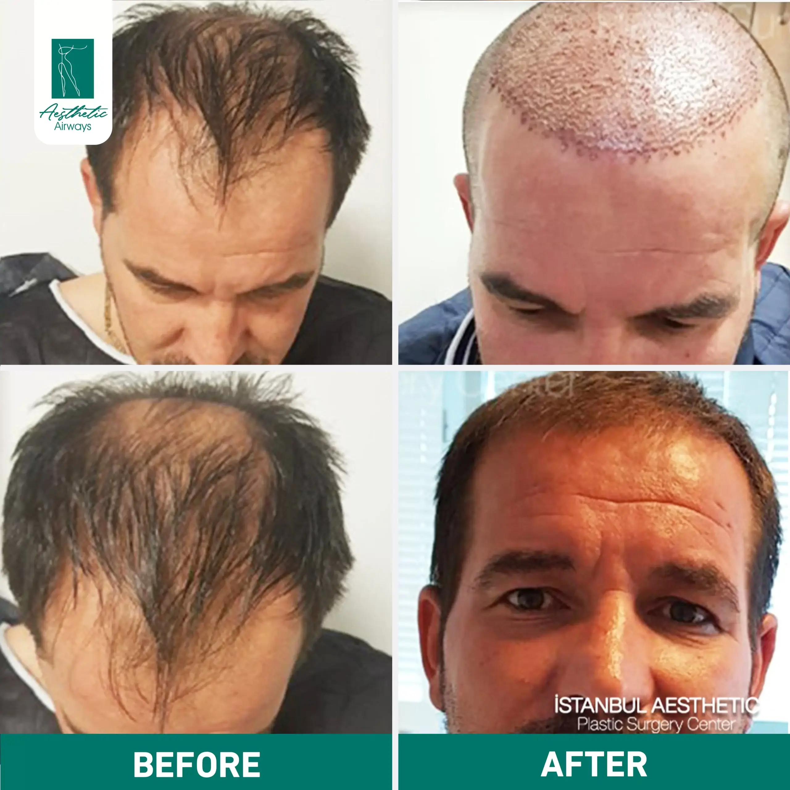 Hair Transplant